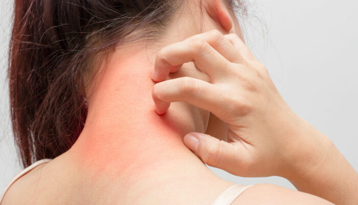 Causes and treatments for common skin allergies