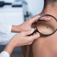 Causes and risk factors of skin cancer