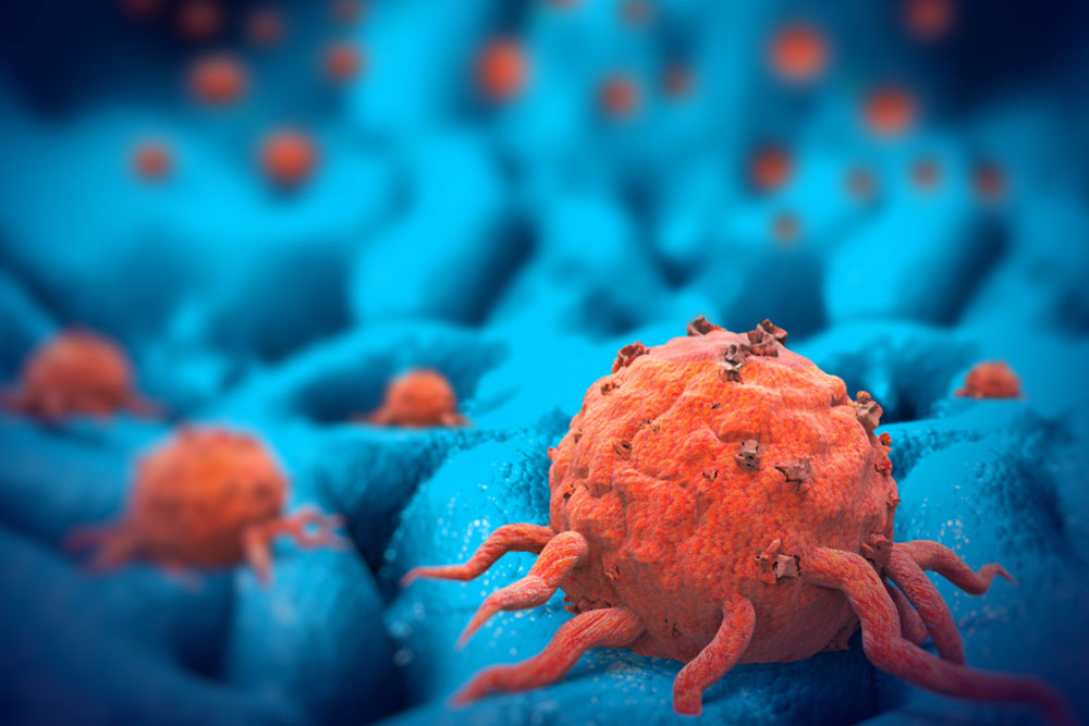 All about carcinoid tumors in the lungs and digestive tract