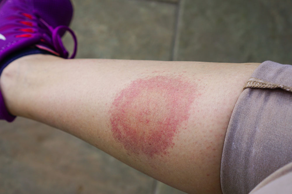 How to prevent lyme disease